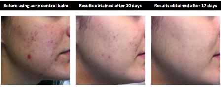 Acne Treatment Pack